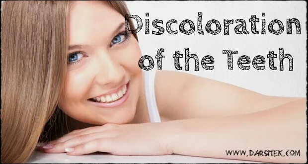 Discoloration of the Teeth