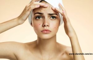 relieve acne
