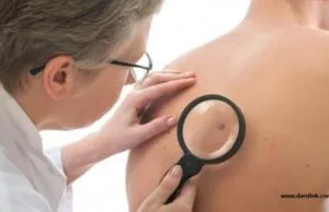 Beware of the 5 Signs of skin cancer that is often Overlooked signs of skin cancer
