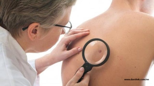 signs of skin cancer